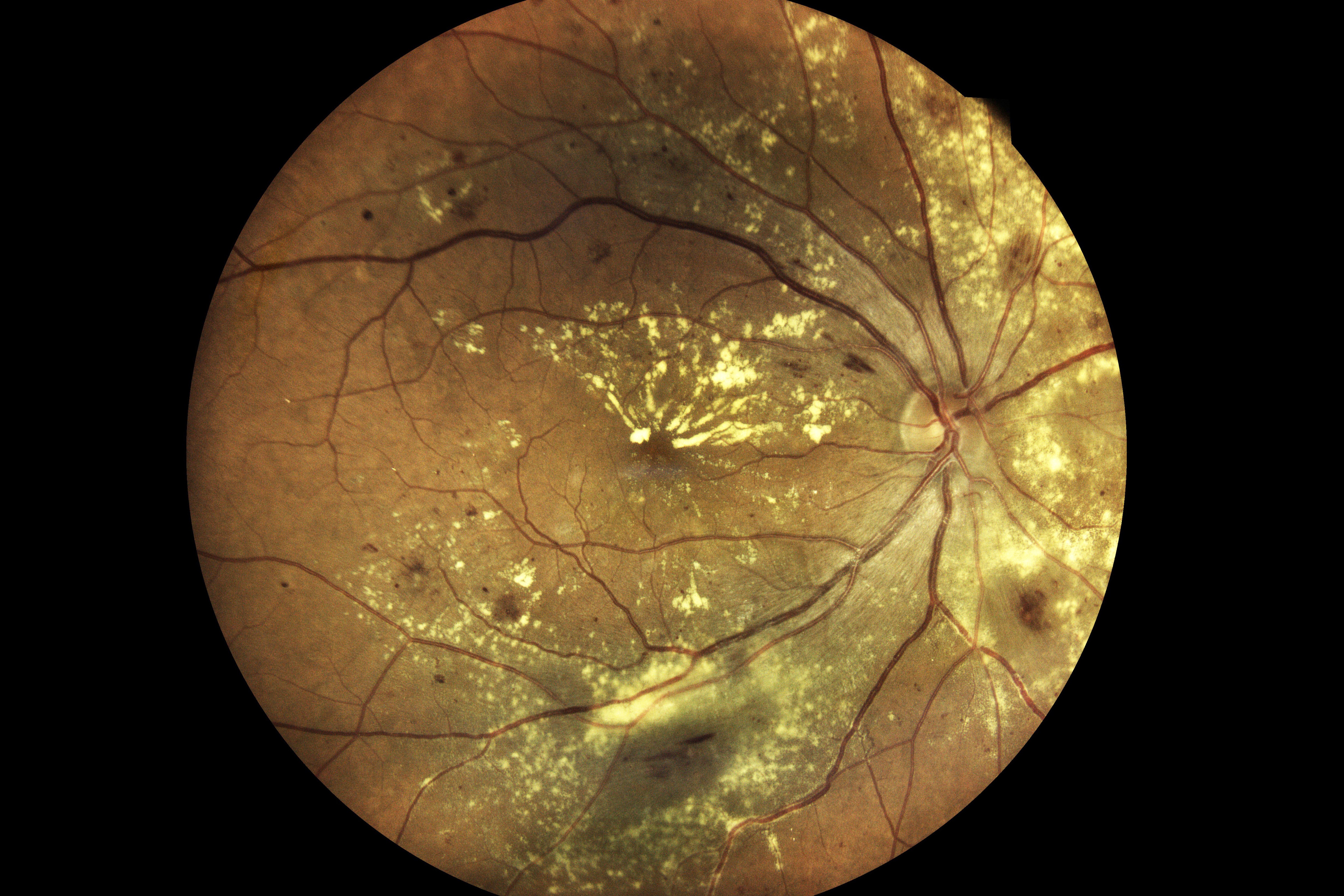 Close up photogragh of an eye with Age Related Macular degeneration