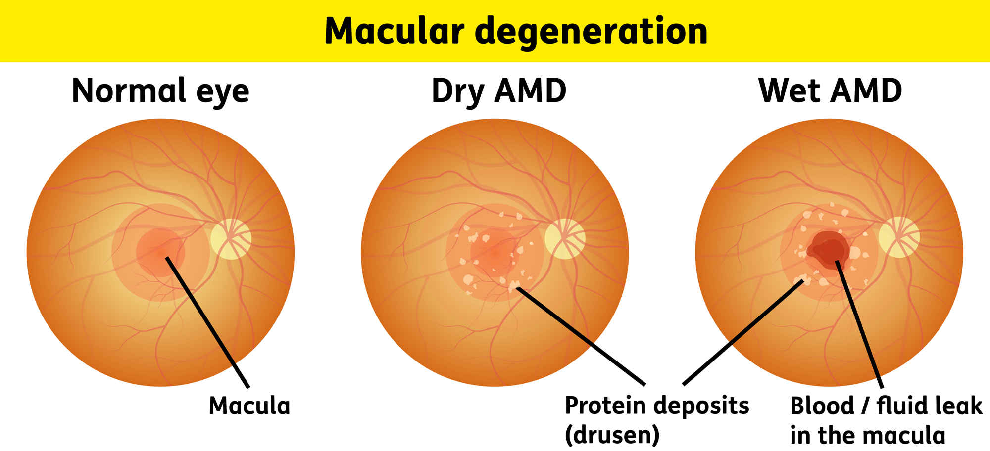 Diagram of macular degeneration showing the comparison between a normal eye, an eye with dry AMD and an eye with wet AMD. Shows protein deposits (drusen) on dry and wet AMD and blood/fluid leak on wet AMD